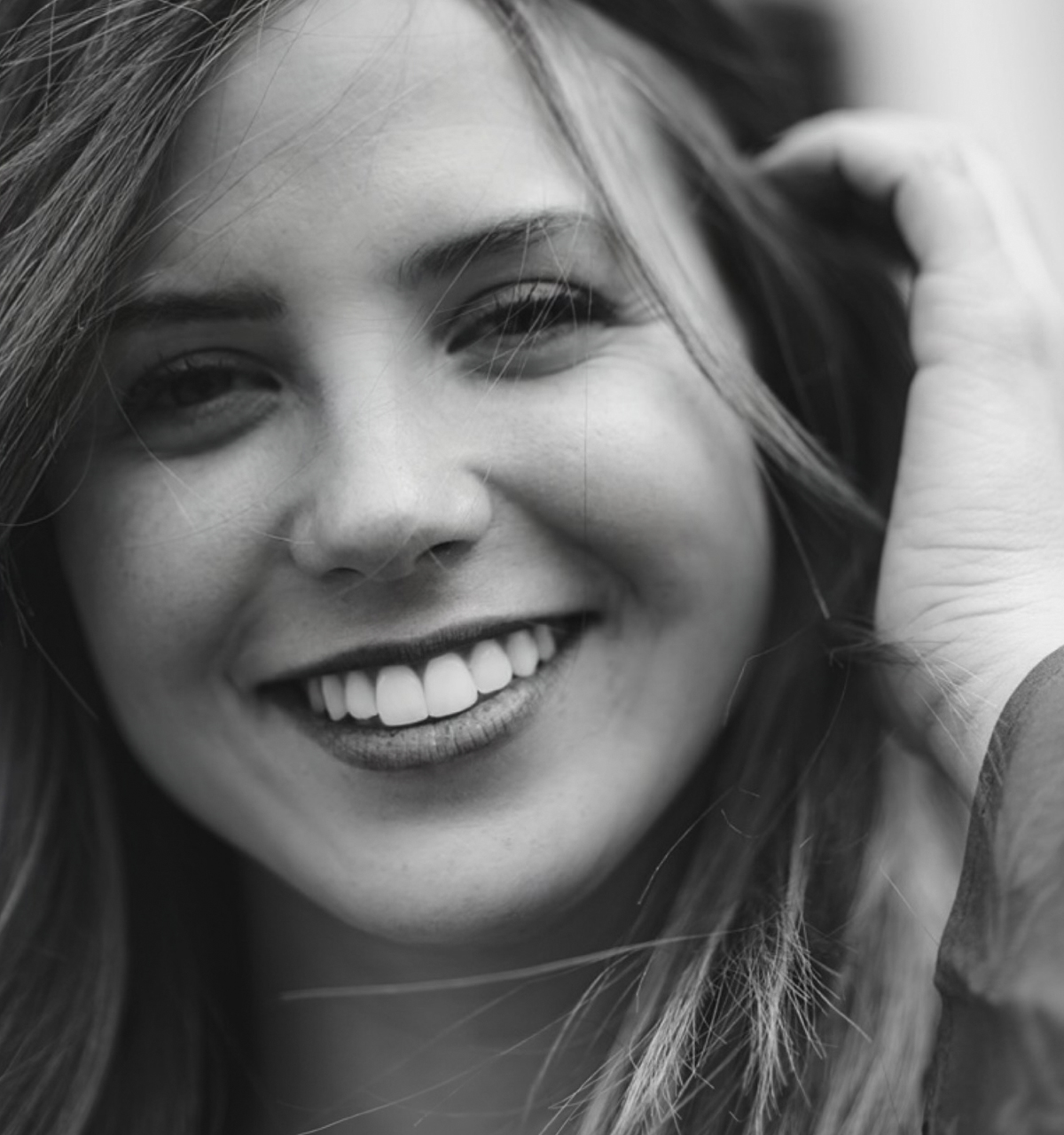 resultados blanqueamiento dental madrid