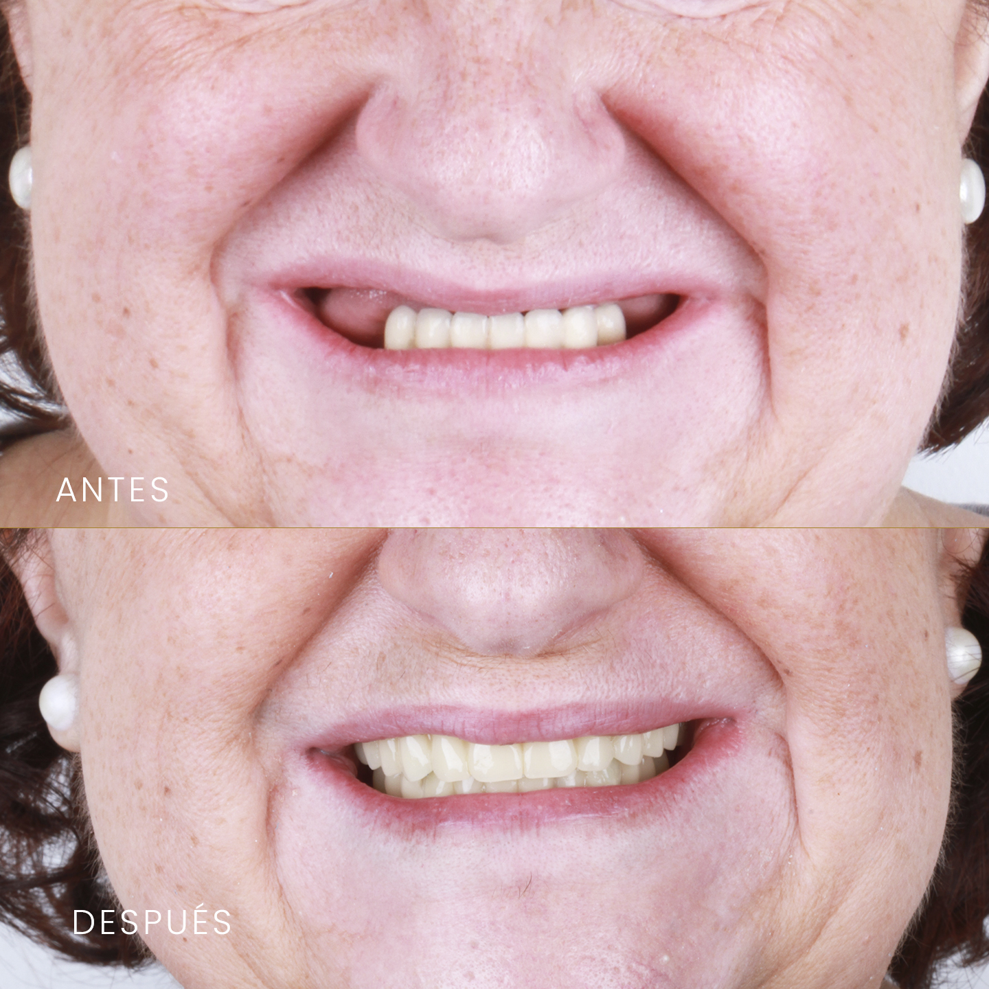https://sonriemadrid.es/wp-content/uploads/2025/08/antesdespuesimplantes.jpg