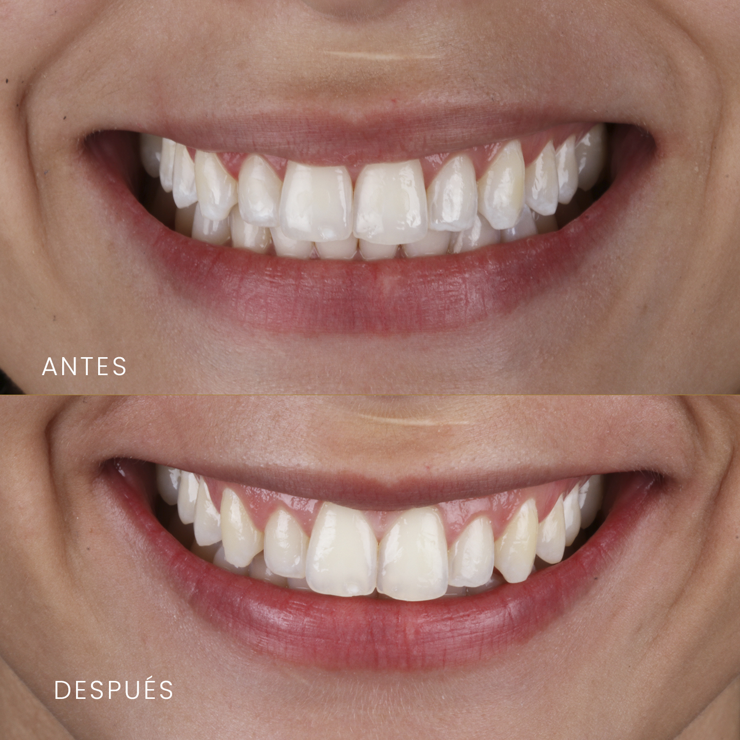https://sonriemadrid.es/wp-content/uploads/2025/08/casoesteticadentalcarillayblanqueamiento.jpg
